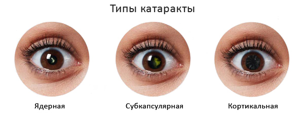 типы катаракты